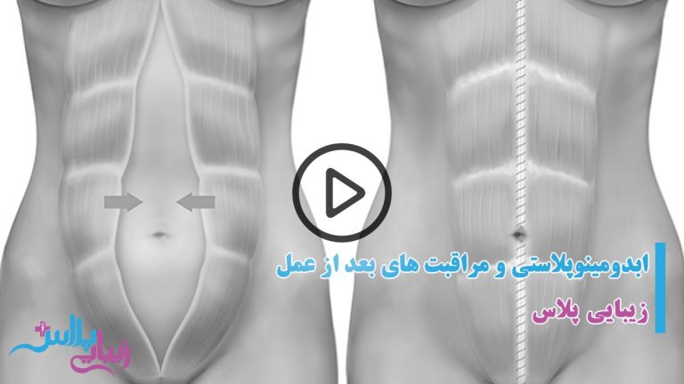 فیلم جراحی ابدومینوپلاستی انیمیشین.jpg