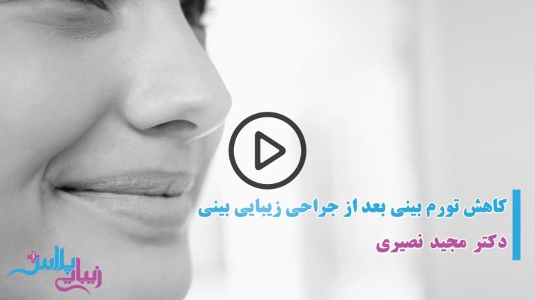 کاهش تورم بینی بعد از عمل رینوپلاستی.jpg