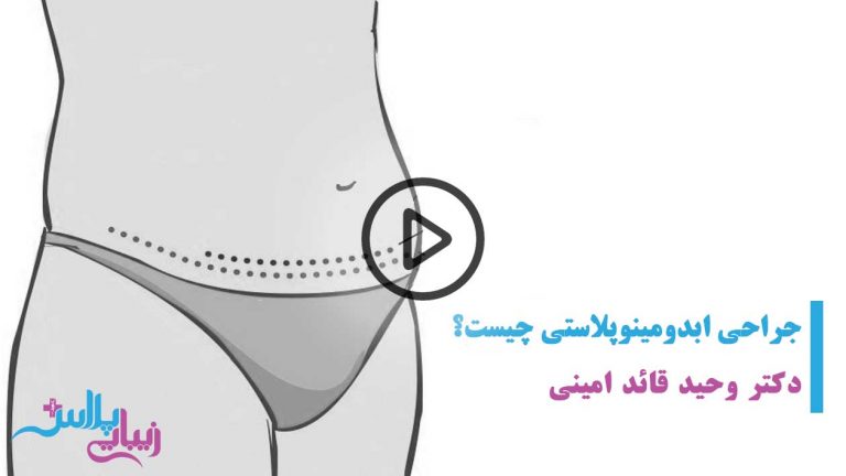 ابدومینوپلاستی,ابدومینوپلاستی بازو