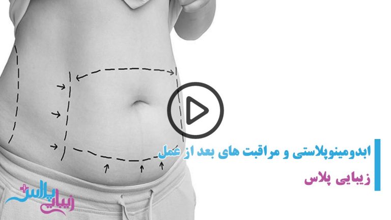 جراحی ابدومینوپلاستی و مراقبت های بعد از ابدومینوپلاستی.jpg