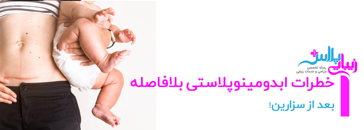 cesarean abdominoplasty.jpg