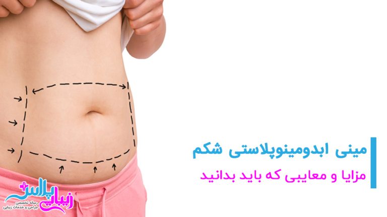 mini abdominoplasty 2.jpg